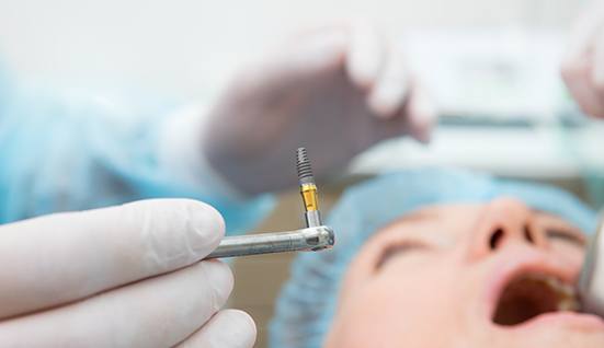 Closeup of a dental implant screw that’s about to be inserted into patient’s mouth