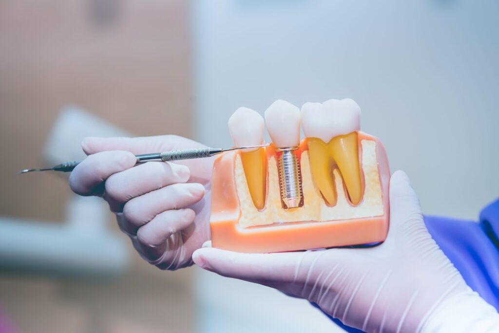 Dentist pointing to large model dental implant's components