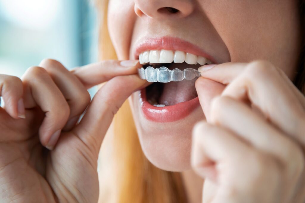 Woman placing Invisalign over top arch of teeth