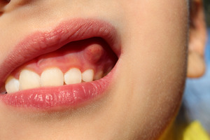 Why is There a Bump on Your Gums? 4 Possible Causes