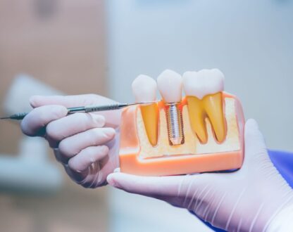 Material Musings: How Long Do Dental Implants Last?