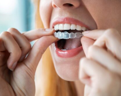Single-Arch Solution: Can Invisalign Treat One Row of Teeth?
